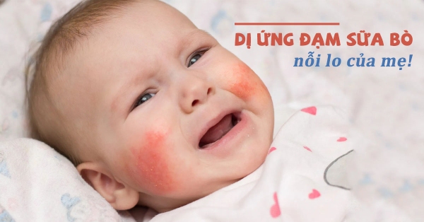 bé dị ứng đạm bò